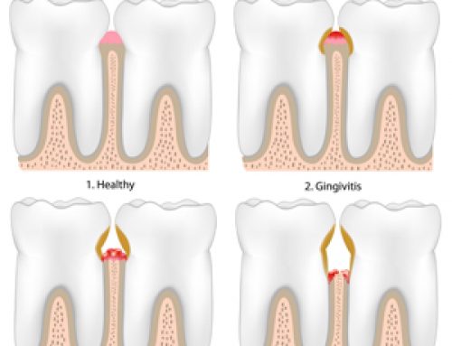 What to Know About Gum Disease