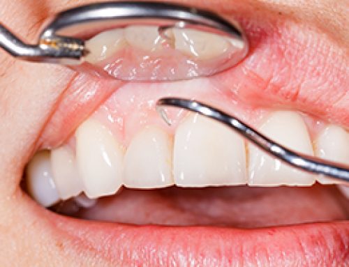 Could You Have Gum Disease?