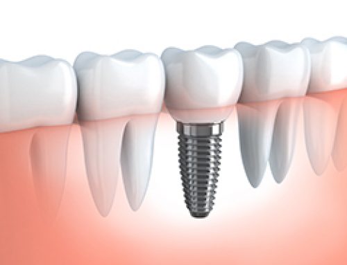 Dental Implants: The Next Best Thing to Natural Teeth